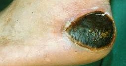 Yatalak Hastalarda Gorulen Yatak Yaralari