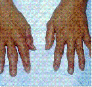 a rheumatoid arthritis