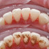 Cách lấy cao răng bật ra từng mảng, hôi miệng kinh niên cũng khỏi ngay sáng hôm sau!