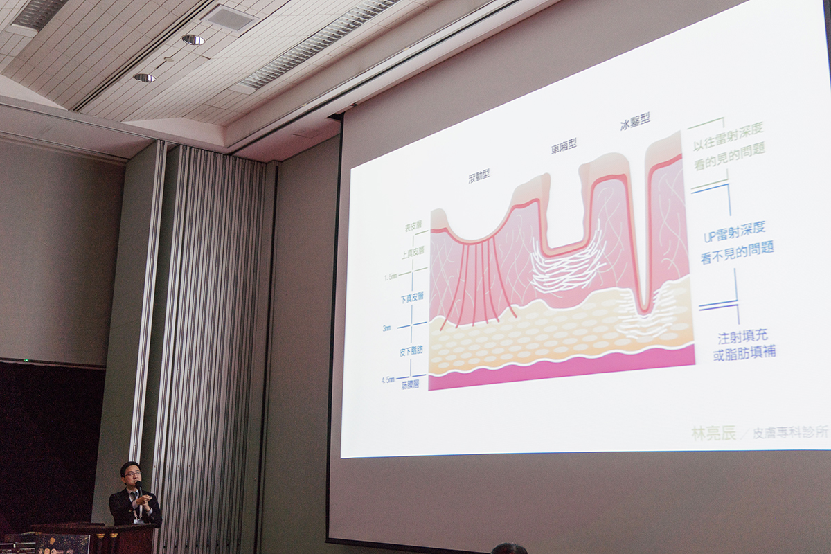 PicoSure755皮秒雷射蜂巢式聚焦陣列透鏡蜂巢皮秒雷射雀斑痘疤毛孔細紋新竹推薦林亮辰皮膚專科診所林亮辰醫師UP雷射UltraPulse痘疤凹疤痘疤淡化凹疤修復凹疤ptt凹洞治療費用 PicoSure755皮秒雷射蜂巢式聚焦陣列透鏡蜂巢皮秒雷射雀斑痘疤毛孔細紋新竹推薦林亮辰皮膚專科診所林亮辰醫師UP雷射UltraPulse痘疤凹疤痘疤淡化凹疤修復凹疤ptt凹洞治療費用
