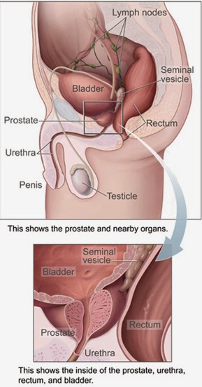 kanker prostat