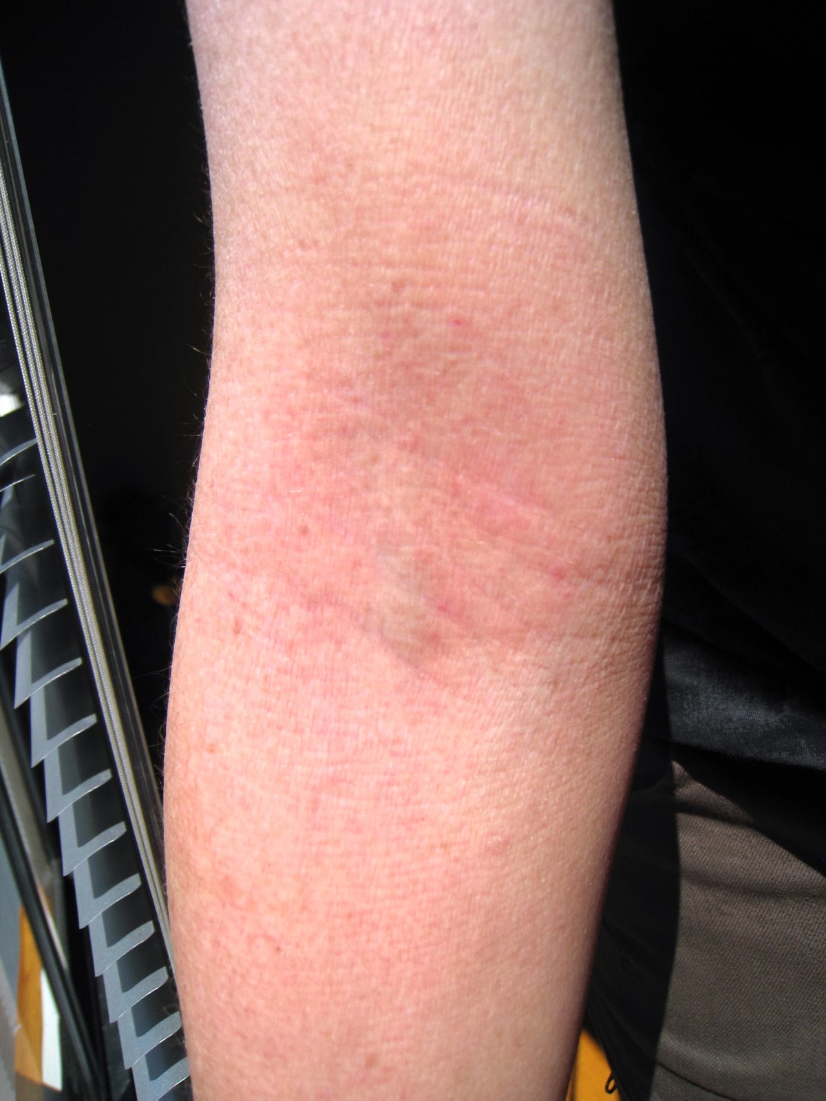 topical-steroid-withdrawal-journey-healing-eczema-and-red-skin-syndrome