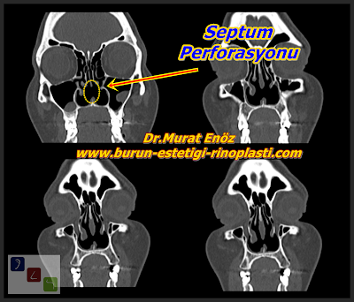 Septum perforasyonu tanımı - Septum perforasyonu nedenleri - Septum perforasyonu belirtileri - Septum perforasyonu tedavisi - Açık teknik septum perforasyonu ameliyatı - Açık teknik septum perforasyonu onarımı - Burun duvarında delik Septum perforasyonu tanımı - Septum perforasyonu nedenleri - Septum perforasyonu belirtileri - Septum perforasyonu tedavisi - Açık teknik septum perforasyonu ameliyatı - Açık teknik septum perforasyonu onarımı - Burun duvarında delik