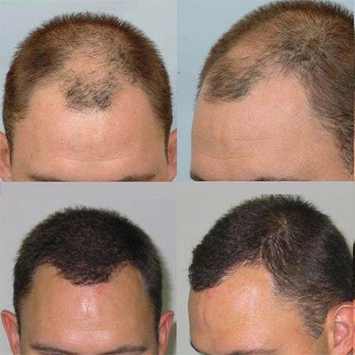 Best Hair Transplant In Phoenix Revive Hair Restoration By Best