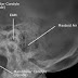 Teknik Radiografi Skull (Mastoid : Proyeksi Axiolateral Schuller Method)
