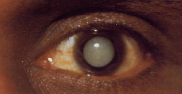 Cataracts, The Pictures, Images & Photos | Photobucket