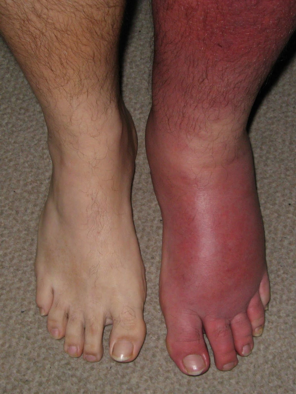 Causes of Red Swollen Feet & Ankles | LIVESTRONG.COM