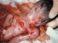 abortus provokatus