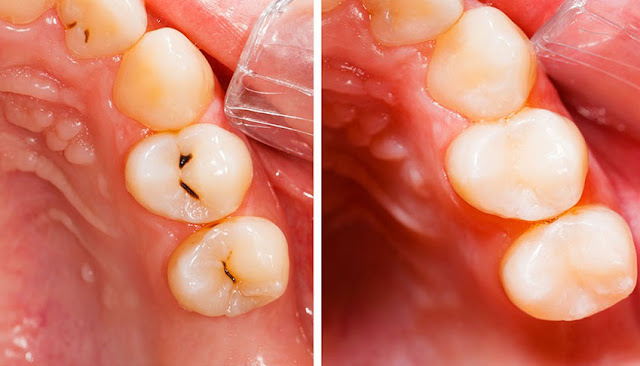 photo of before and after tooth colored cosmetic dental filling.