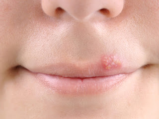 oral herpes for herpes type