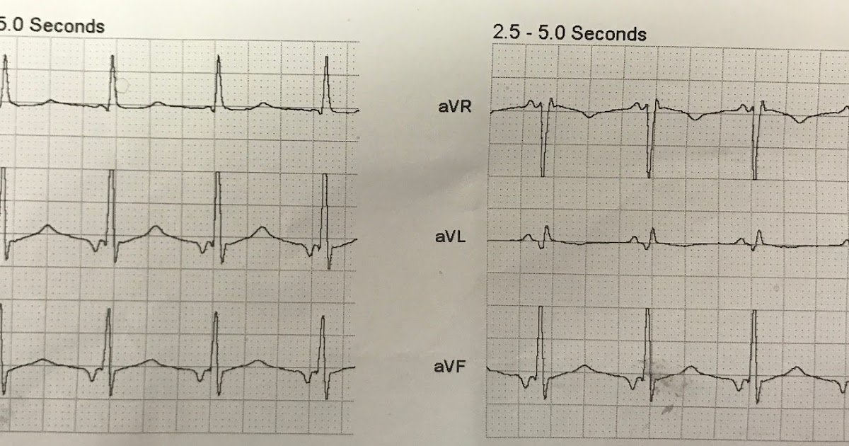 Dr. Smith's ECG Blog Syncope and Prehospital Cath Lab Activation for