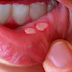 Causes Of Mouth Ulcers And How To Treat This Condition