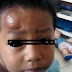 obat herbal untuk menyembuhkan benjolan di kening atas mata