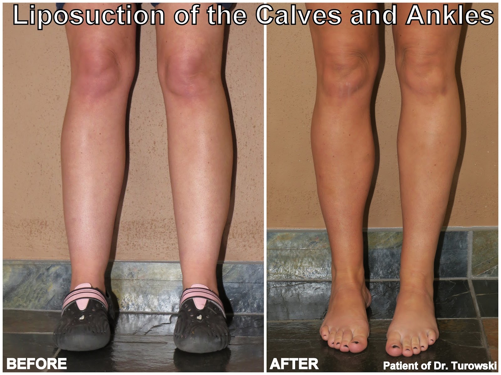 New Horizons Plastic Surgery Liposuction of calves and ankles
