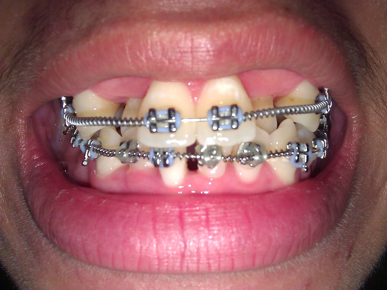 \u0e01\u0e32\u0e23\u0e08\u0e31\u0e14\u0e1f\u0e31\u0e19 Orthodontic: \u0e23\u0e35\u0e27\u0e34\u0e27 4 \u0e40\u0e14\u0e37\u0e2d\u0e19\u0e17\u0e35\u0e48 7 \u0e02\u0e2d\u0e07\u0e01\u0e32\u0e23\u0e08\u0e31\u0e14\u0e1f\u0e31\u0e19