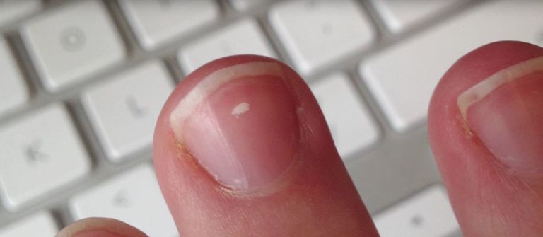 White spots on nails happy hospitals