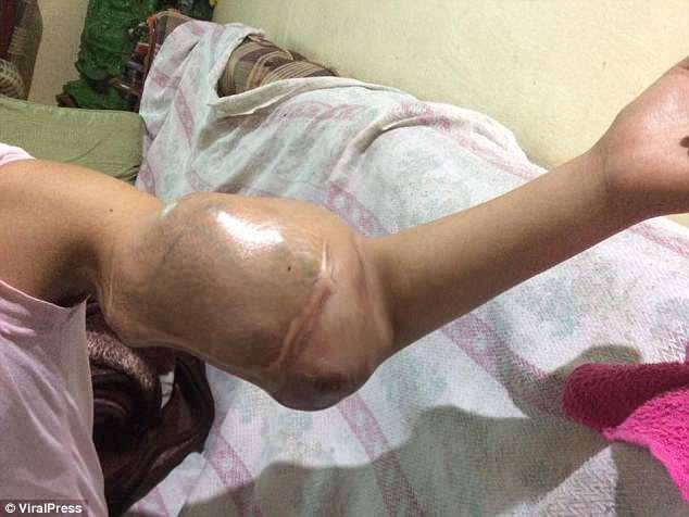 ''Ingatkan Bekas Gigitan Nyamuk, Rupanya Kanser Bila Tangan Bengkak Tiba-Tiba'', Lengan Gadis Ini Terpaksa Dipotong ''Ingatkan Bekas Gigitan Nyamuk, Rupanya Kanser Bila Tangan Bengkak Tiba-Tiba'', Lengan Gadis Ini Terpaksa Dipotong