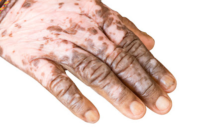 Cara Mengobati Penyakit Vitiligo