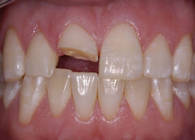 Trám răng cửa bị gãy có hiệu quả không? 