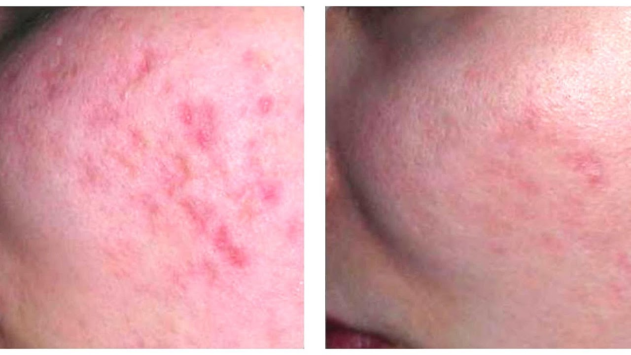 Chicken Pox Scar Removal Before And After Chicken Choices