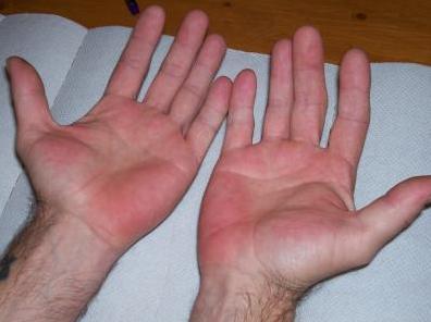 bright red cold hands - Vascular and Circulatory Disorders ...