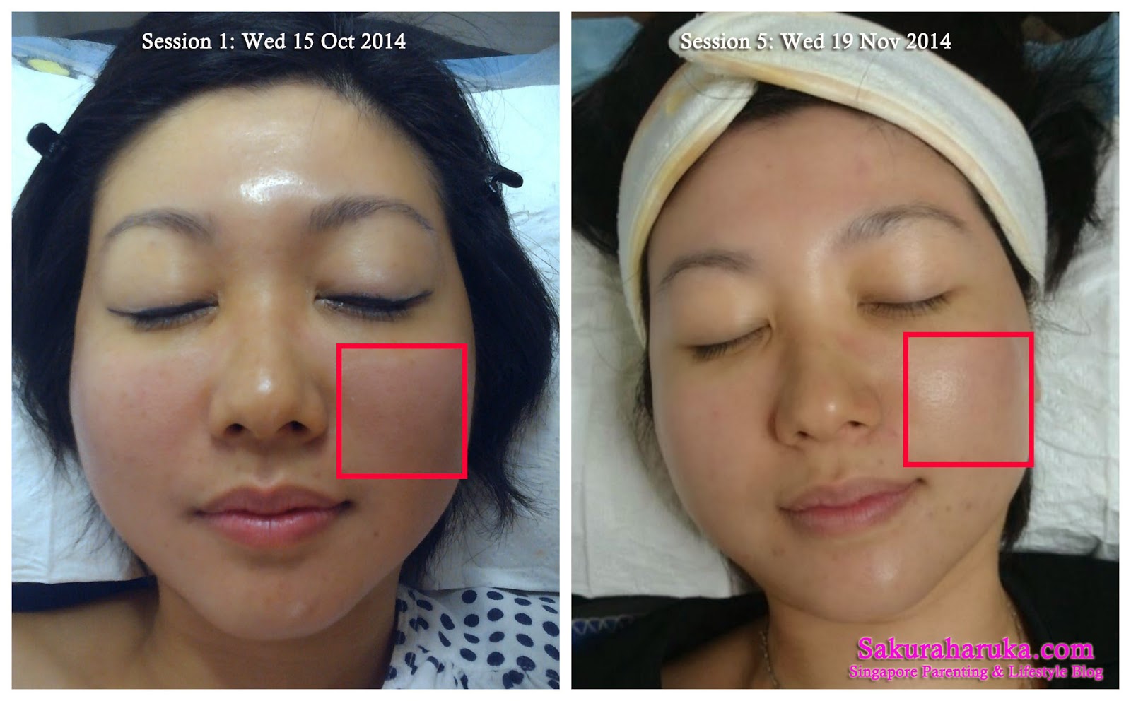 Ipl Face Treatment Before After Doctor Heck