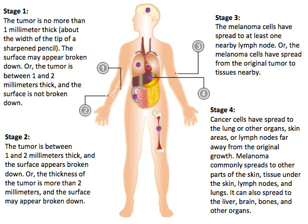 kidney cancer stages