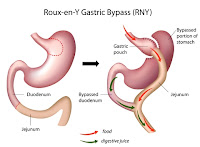 Gastric bypass