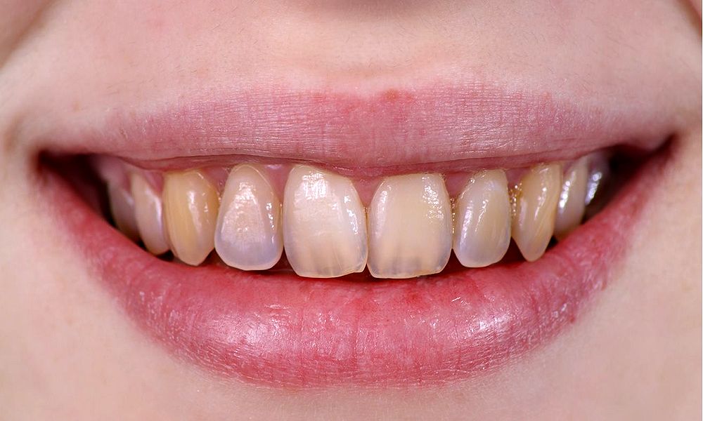 This Is Why Teeth Become Yellow Directorio Odontol gico This Is Why Teeth Become Yellow Directorio Odontol gico