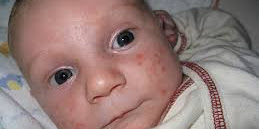 Child acne comes and goes throughout the day