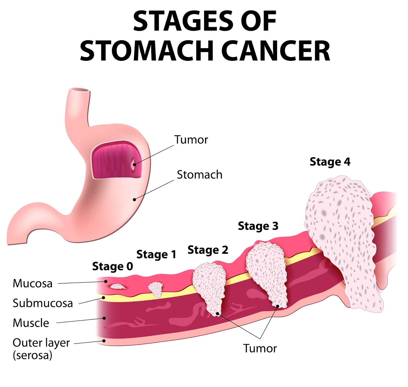 gastric cancer symptoms