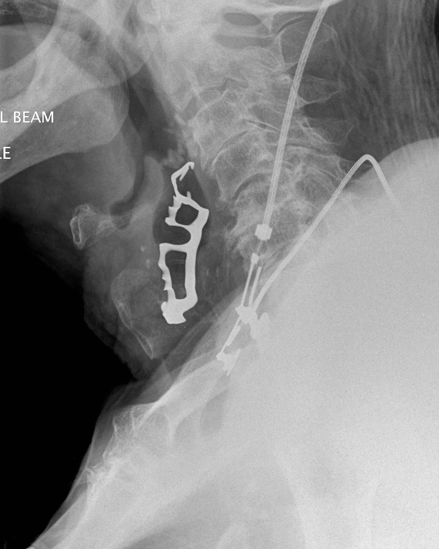 Dr. Na'ama Attar What should you do if you swallow a dental bridge or a denture?