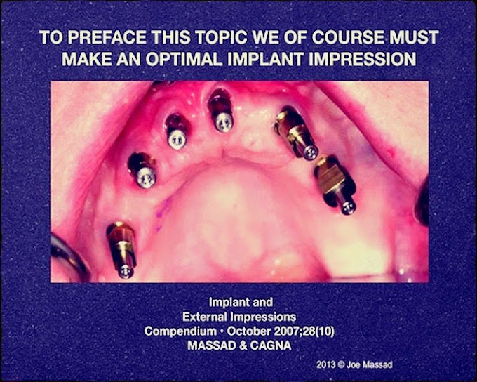 WEBINAR: Making Accurate and Complex Implant Models within Minutes - Joe Massad