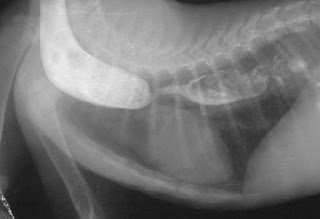 Radiograph of esophageal stricture