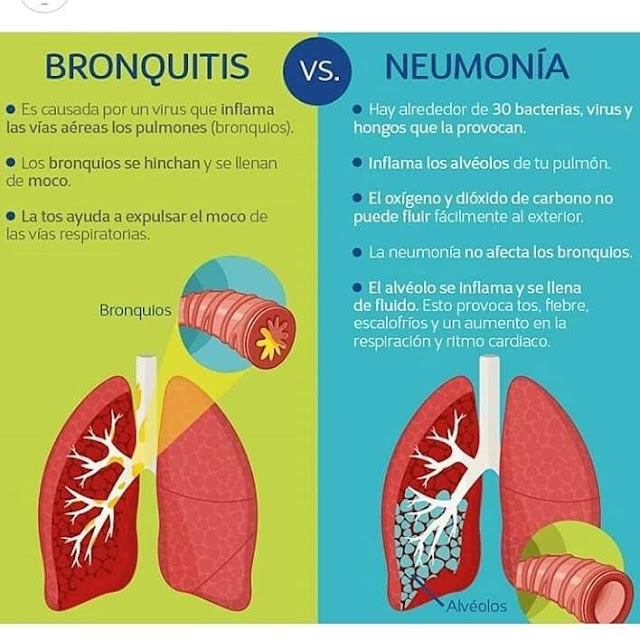 Diferencia Entre Bronquitis Y Neumonia ~ Consultas Medicas Online