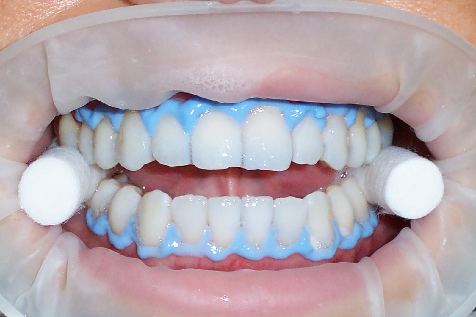 Blog de OdontoPack BLANQUEAMIENTO DENTAL Blog de OdontoPack BLANQUEAMIENTO DENTAL