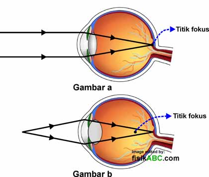 miopie hipermetropie astigmatism