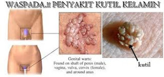 Foto Cara mengobati kutil kelamin dengan cuka