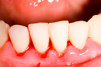 Nhận biết viêm nướu răng ở trẻ em 
