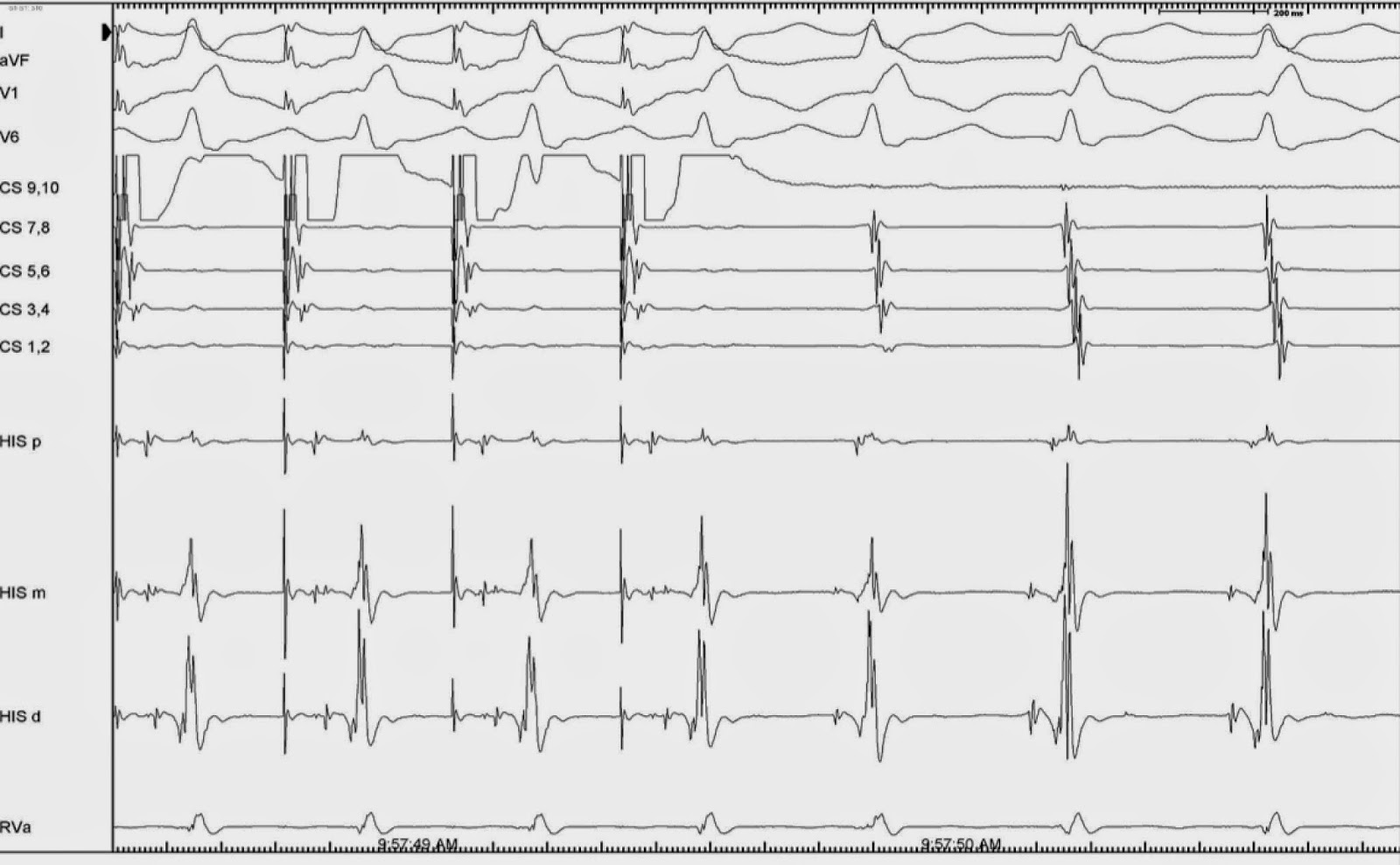 A Year at the Royal Brompton Hospital Atrial extrastimuli, atrial overdrive pacing for SVT