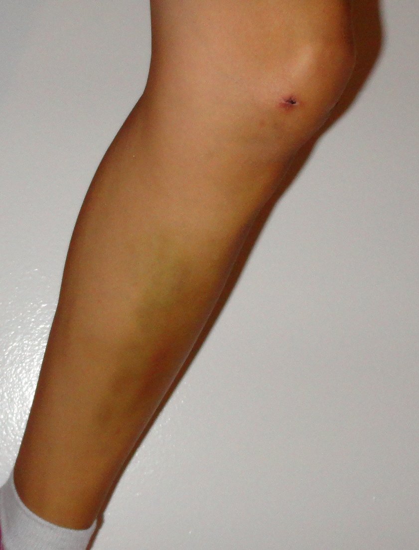 Mellissa Rose Two Weeks After Knee Surgery