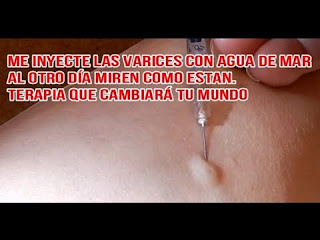 las varices desaparecen en un dia