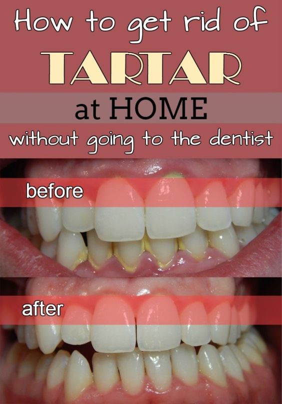 how-to-get-rid-of-tartar-at-home-without-going-to-the-dentist-healthy-mom