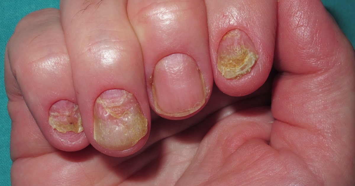 Los hongos en las uñas es una afección frecuente y potencialmente  contagiosa  Salud y Medicina