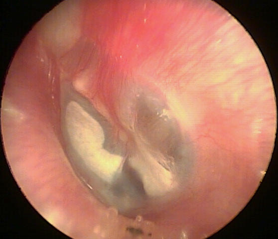 white patches on eardrum