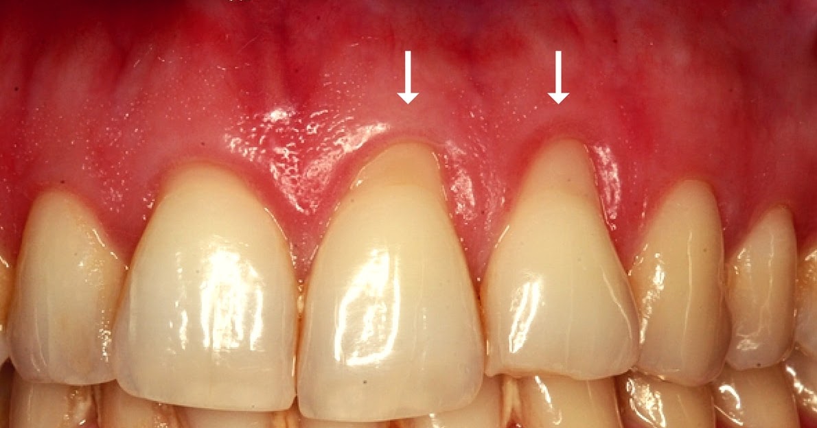 Stadsklev Dental Blog What is Gum Recession and Why is it a Concern?