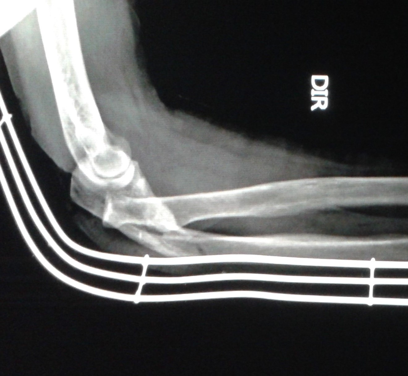 DICAS DE RADIOLOGIA Tudo Sobre Radiologia IMAGENS RADIOLÓGICAS FRATURA ULNA COTOVELO DICAS DE RADIOLOGIA Tudo Sobre Radiologia IMAGENS RADIOLÓGICAS FRATURA ULNA COTOVELO
