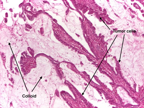 موقع الدكتور أحمد كلحى: صور باثولوجى -- ﻿Patholgy Slides : Tumors or ...