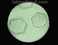 Urine Microscopic - Cystine crystals
