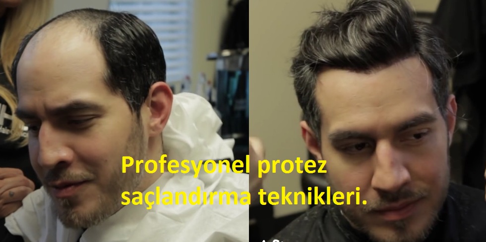 Protez Sac Protez Sac Istanbul Protez Sac Ankara Aralik 2016